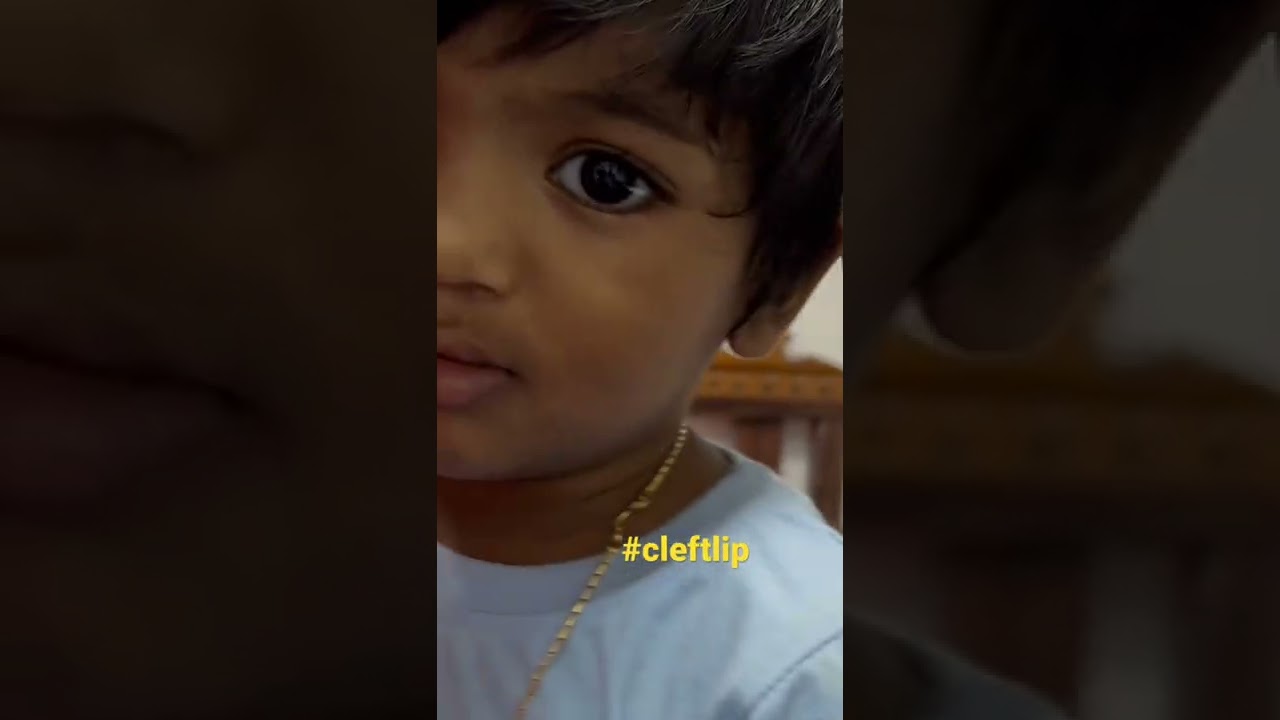 Cleft lip repair2 years after surgery