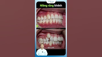 Quá Trình Niềng Răng Khấp Khểnh | Bác Sĩ Yên