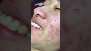 Squeeze acne - Relax Every Days (27)| Dr Hưng S Beauty