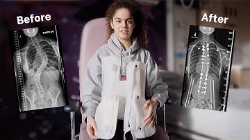 Scoliosis surgery using the Mazor X Stealth surgical robot: Emma