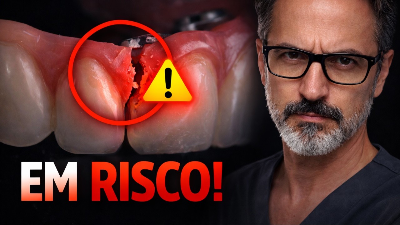 6 Erros que Colocam Sua Prótese Protocolo em Risco (que os dentistas não contam)