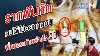 รากฟันหักครึ่ง!! แต่คนไข้ไม่อยากถอน พี่หมอจะทำอย่างไร ?!! | คลายปัญหารากฟันเทียมกับหมอโชค