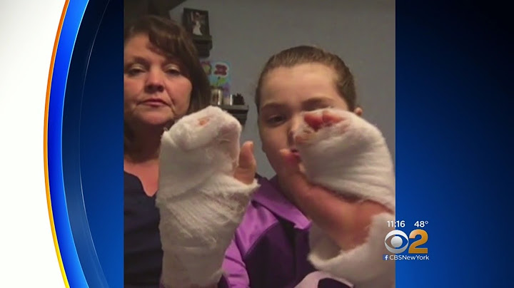 Parent Issues Warning After 11-Year-Old Daughter Suffers Burns While Making 'Slime"