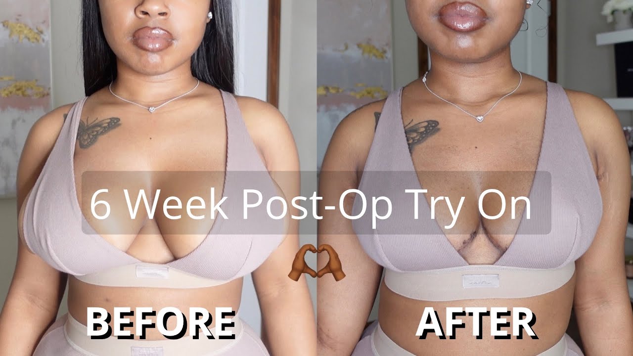 Breast Reduction Recovery Week By Week