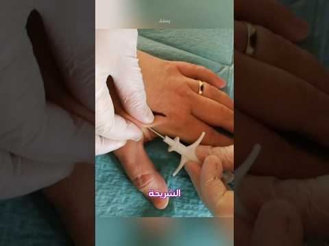 شريحة تحت الجلد بداية عصر جديد