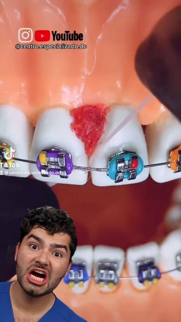 Braces Flossing Hack