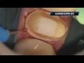 Posterior Crown Troughing with a Diode Laser
