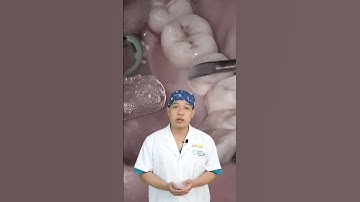 Lấy Cao Răng, Vôi Răng Quá Nhiều