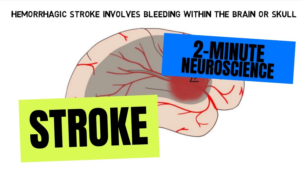 Инсульт ютуб. Stroke.