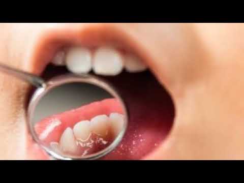 Video La caries dental: una enfermedad silenciosa que afecta a miles de ecuatorianos