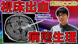 【脳卒中×理学療法】視床出血の病態生理に関する知識をわかりやすく解説します！