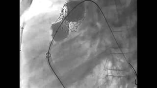 Vol. 3 Issue 3 - Video 1D Transcatheter Pulmonary Valve Replacement The Edwards Valve