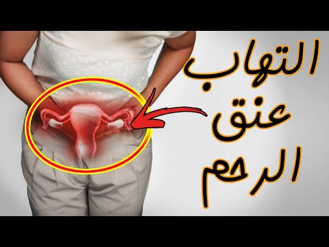 التهاب عنق الرحم الأسباب الأعراض التشخيص العلاج 
