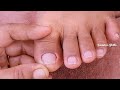 Satisfying pedicure|Ingrown removal|Square shape nail(Part13) | Beauty&#39;s Skills