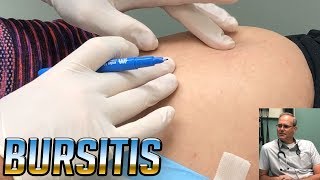 Lil Montanas Bursitis Injections