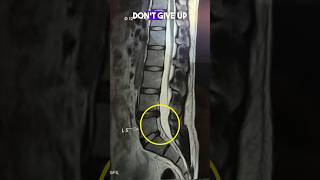 Lumbar disc bulges recovery after 4 years #sciatica #backpain #gym #l4l5 #mri #sciaticapainrelief