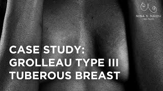 Case Study: Grolleau Type III Tuberous Breast | Nina s. Naidu MD FACS | NYC Plastic Surgeon