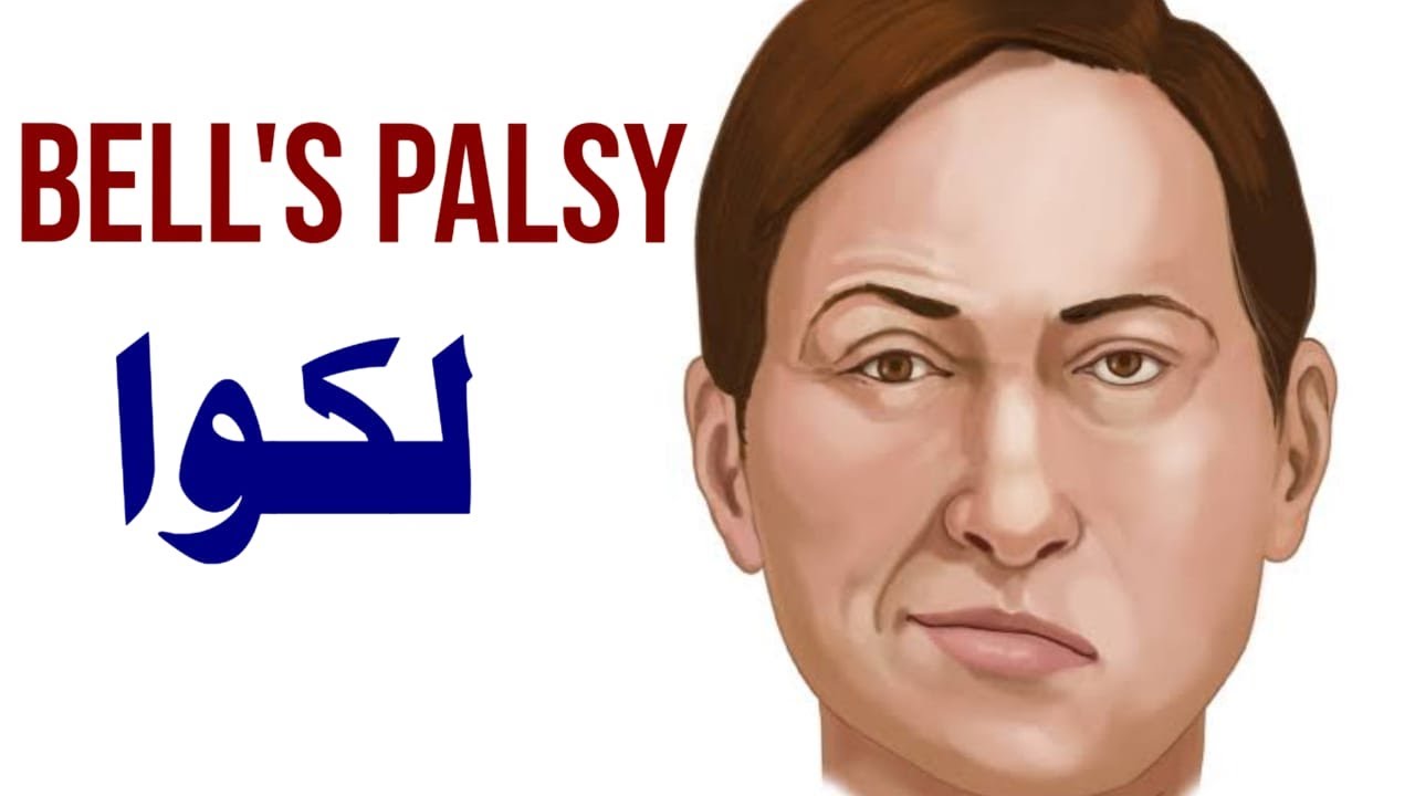 Bell's Palsy Urdu/Hindi YouTube