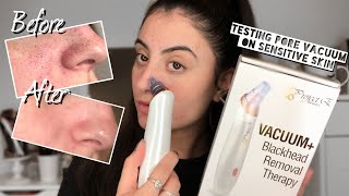 TESTING VACUUM BLACKHEAD REMOVER ON SENSITIVE SKIN | Project E Beauty Vacuum Blackhead Extractor