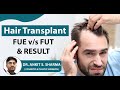 Hair Transplant Explained: FUE vs FUT - Procedure, Process, and Results | Dr. Ankit Sharma
