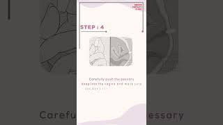 Vaginal Pessary : How to insert it during fertility treatment. #ivfjourney #ivfspecialist #fertility