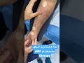 علاج متلازمه المرفق باستخدام تقنيه   الترداد العصبيه