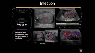 Acute Scrotal Pain Ultrasound Video Lecture