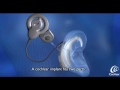 Cochlear Implants - Educational Slideshow