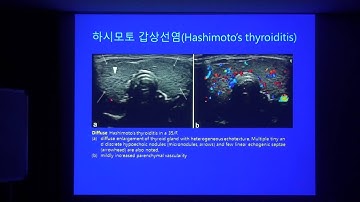 2016.9.7 김일봉 초음파 교실②-미만성 갑상선 질환 배규환 원장