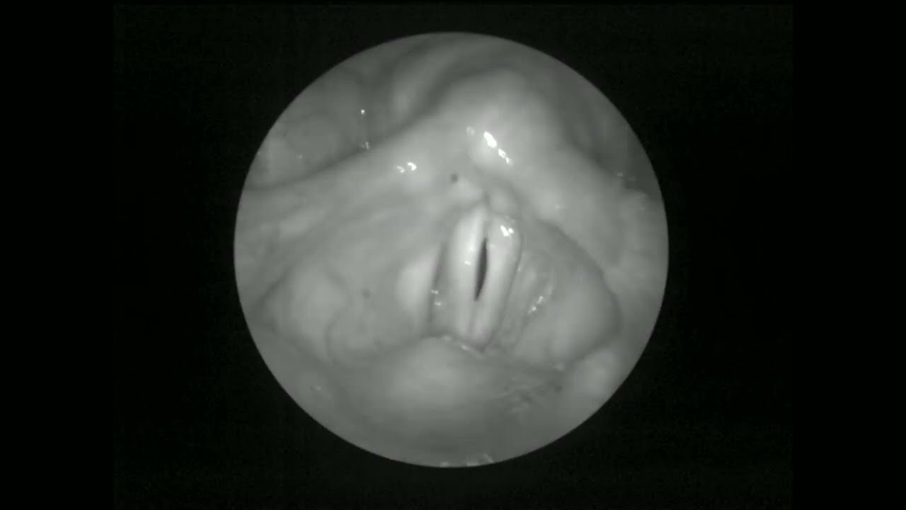 Высокоскоростная визуализация вибрации голосовых складок