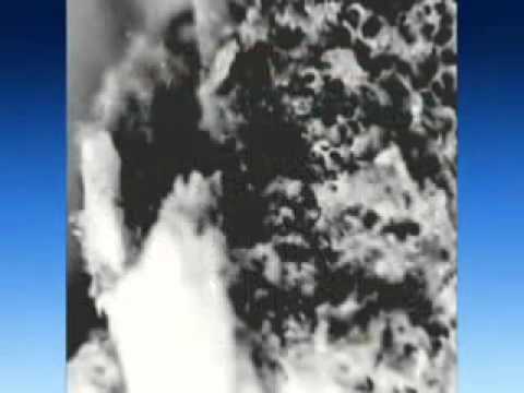 Подвывих шейного позвонка