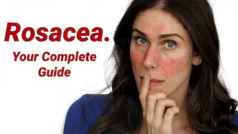 Why Does Everyone Get Rosacea Wrong? What It Is an...