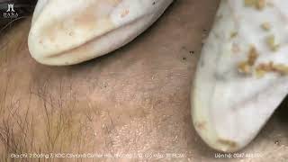 Big Cystic Acne Blackheads Extraction Blackheads & Milia, Whiteheads Removal Pimple Popping