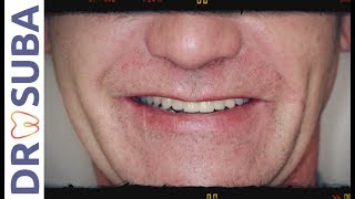 12 implants et 25 dents J&#39;ai tout fait en Hongrie Dr SUBA Csongor