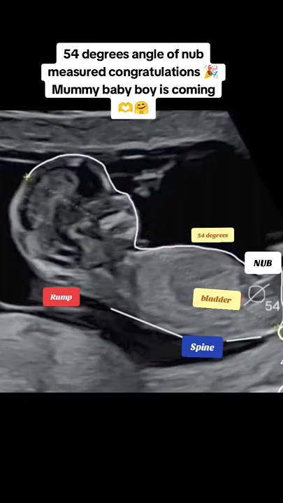 baby boy is coming 🎉 54 degrees angle of nub measured|#pregnancy #baby