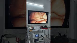 Stryker 1488 CMOS Endoscopic Camera 3 Chip with 26” Vision Pro LED monitor | Vision Clarity