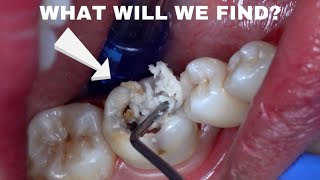 A Very BIG and DEEP Cavity | Dental Caries | Dentist | Dokter Gigi Tri Putra