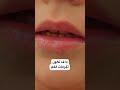 قرح الفم إليك سببا غير متوقع