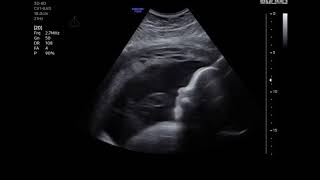 Download Lagu Zwangerschapsduur 29 wkn 2 dgn MP3