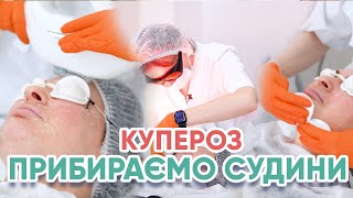 Купероз. Прибираємо судини не пошкоджуючи шкіру.