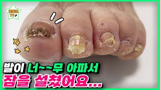 (eng sub)발이 너무 아파서 잠을 설쳤어요...｜레푸스 서면점/사상점｜ingrown toenail｜Athlete&#39;s foot-Fresh Foot