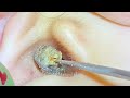 ASMR耳かき:耳が軽くなる快感がクセになる