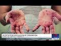Alertan por posible exposición de sarampión en un terminal del Aeropuerto de O'Hare