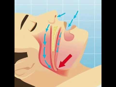 Como hacer que una persona deje de roncar
