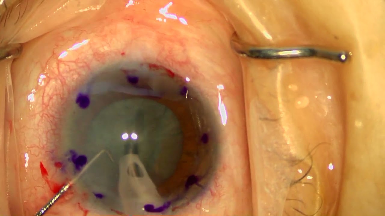 [unedited] Cataract surgery with DMEK