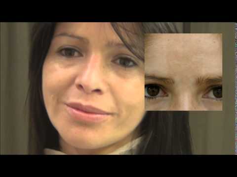 frente obrero Melasma, tratamiento láser