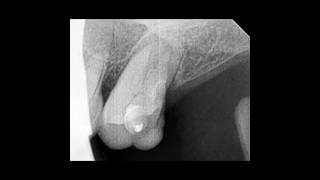 RCT of 27 with narrow and calcified canals #calcification #endo #rootcanal
