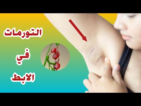 الغدد اللمفاوية في الابط أسبابها و لماذا يجب الحذر منها تورمات الإبط
