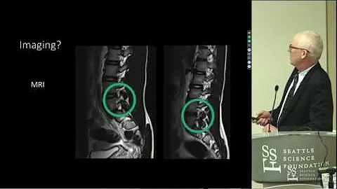 Spondylolysis & Spondylolisthesi...  - Wally Kreng...