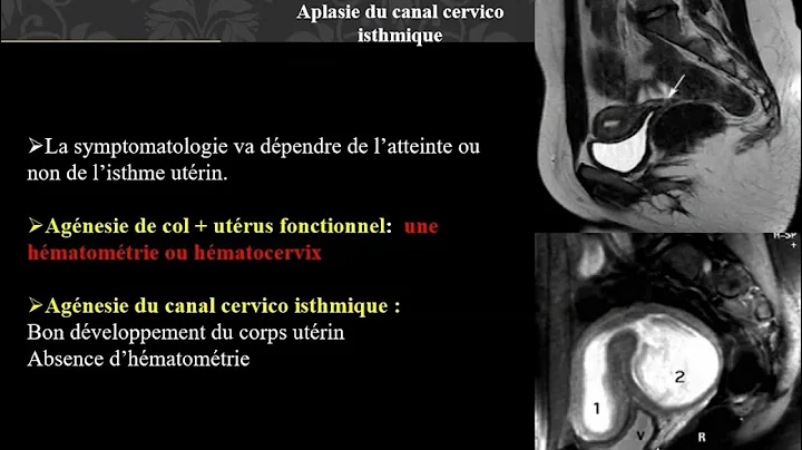 Raisonner devant des anomalies du tractus gnital f...